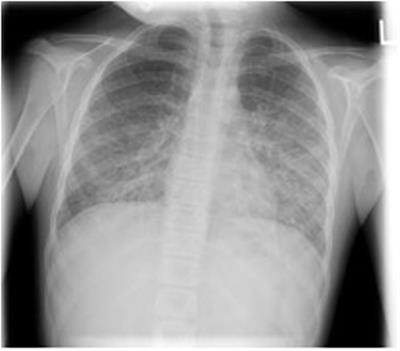 Pneumocystis jirovecii Pneumonia in Pediatric Inflammatory Bowel Disease: A Case Report and Literature Review